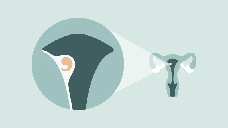 علائم لانه گزینی چیست و چه زمانی شروع میشود؟همراه با عکس