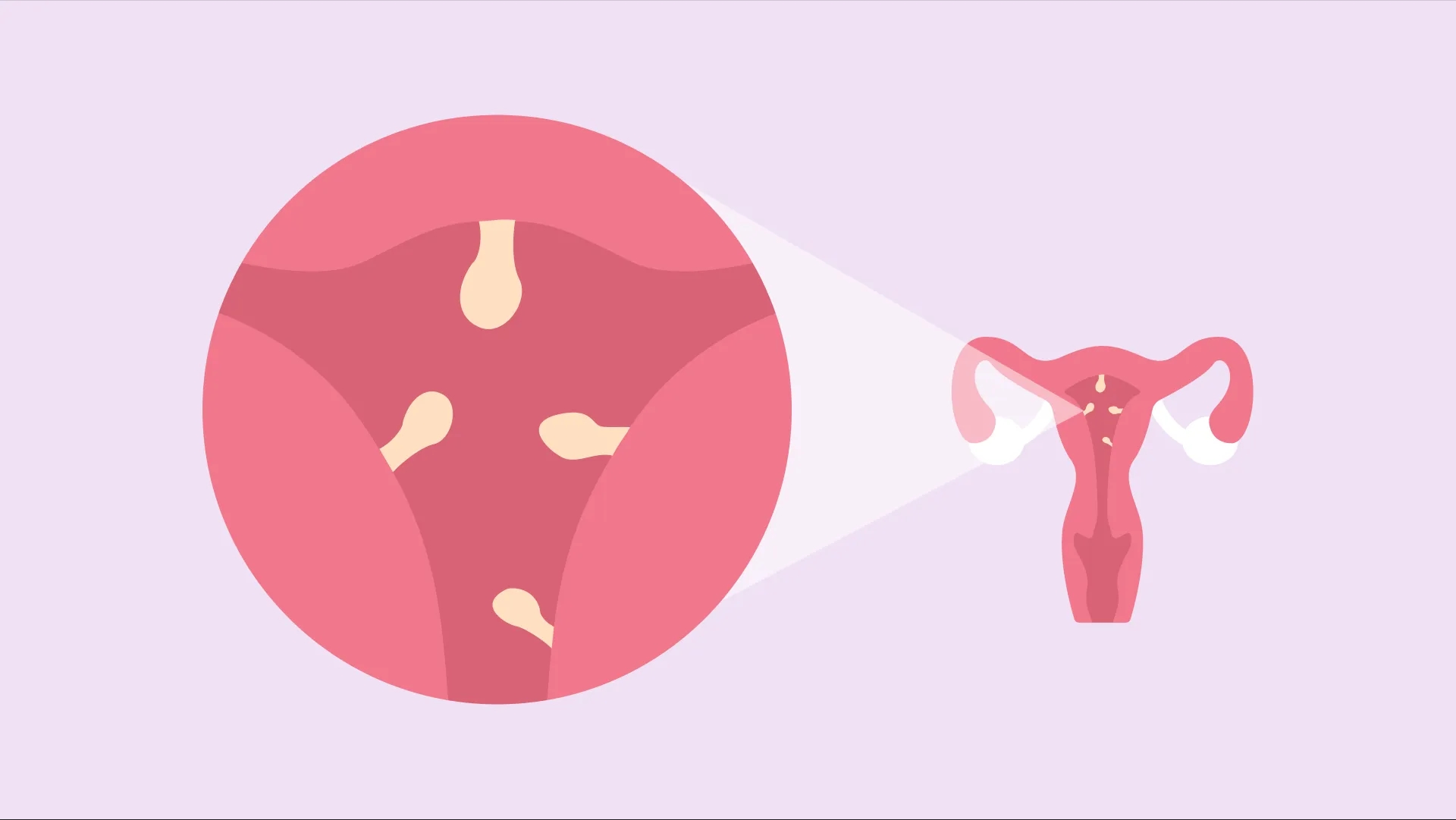 آیا فیبروم رحم خطرناک است؟